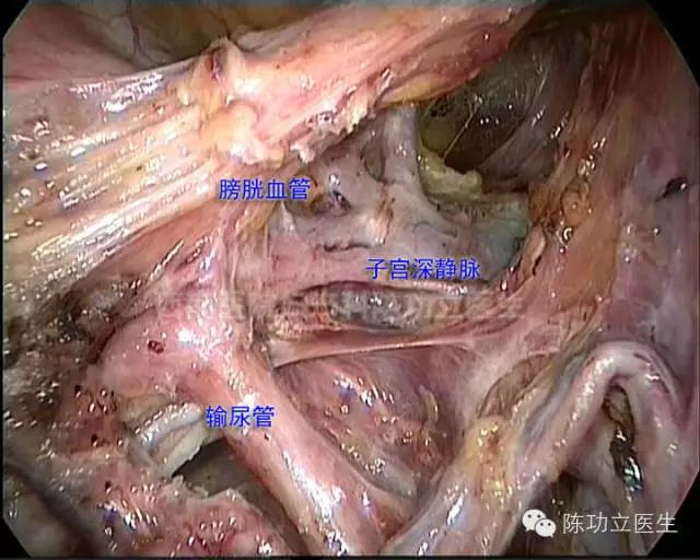 收藏!妇产科手术解剖图谱之血管解剖