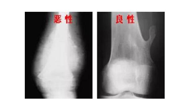 骨头也会得癌,什么是骨软骨瘤?