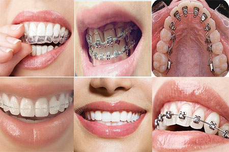 福清戴牙箍为什么能矫正牙齿?