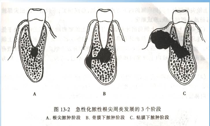 (二)急性化脓性根尖周炎(牙槽脓肿) 【临床表现】 1,自发性,持续性跳