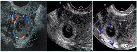 左图黄体囊肿囊内出血形成与卵黄囊非常相似的环状结构,鉴别主要依靠