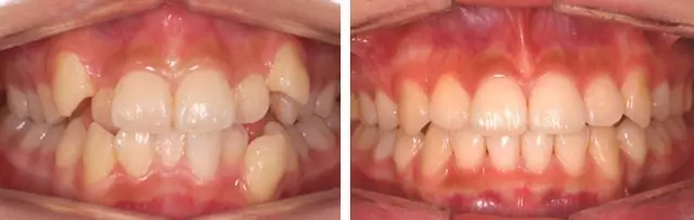 虎牙畸形成功案例牙列不齐成功案例那么就不要继续观望啦,想要变美就