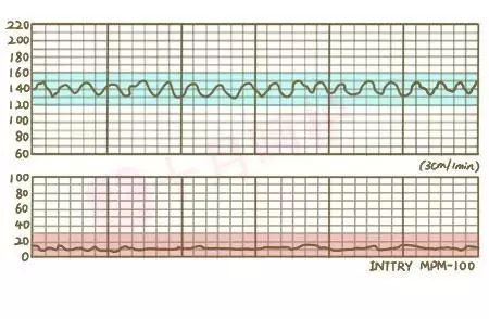 妇产科副主任医师授解释," 胎心监护呈正弦波形是比较罕见的一种情况