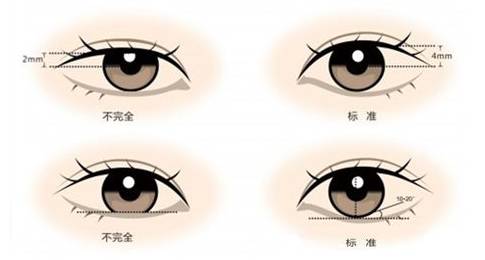 适合做双眼皮的几种眼睛类型,快看看你有没有!
