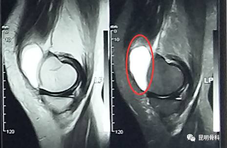 核磁共振示关节积液和退变情况▼