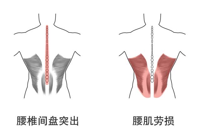 长圆针治疗腰椎间盘突出是什么原理(3)