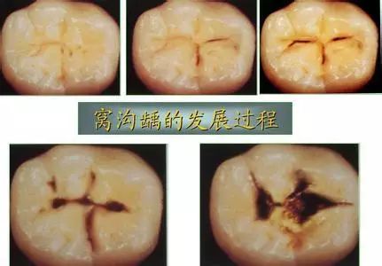 如果你不幸也有这些黑线,河马君要很慎重的告诉你,你已经蛀牙啦!