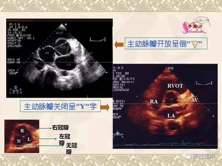 超声心动图常用切面的打法图解