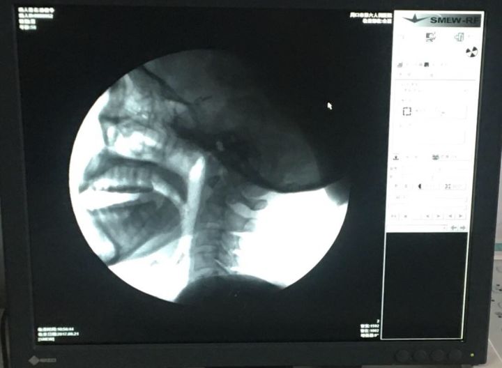 周口也可以做吞咽造影啦六院领先引入吞咽造影技术