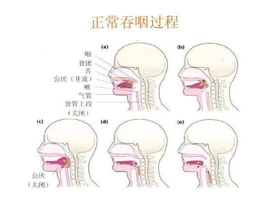 六院领先引入吞咽造影技术