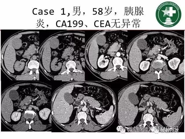 肿块性胰腺炎影像诊断和鉴别诊断