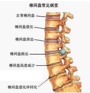 腰椎间盘突出症,千万别盲目手术!90%都可以这样保守治