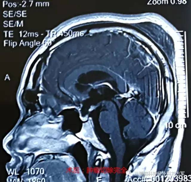 3张片子,1次看清颅咽管瘤手术前后差别