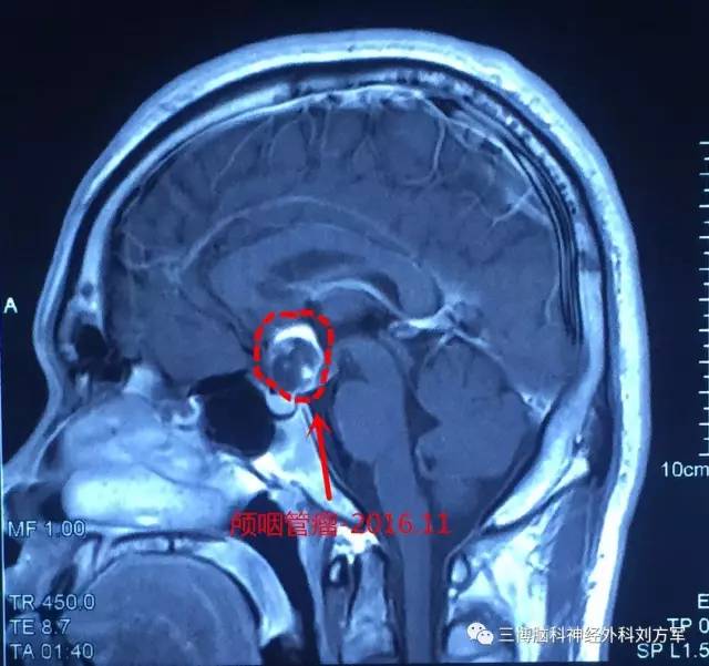 3张片子,1次看清颅咽管瘤手术前后差别