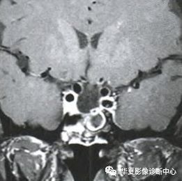 影像交流空泡蝶鞍原来有这么多病因