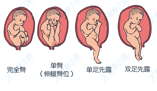 处理: ◆ 臀位分娩,一般头胎选择剖宫产; ◆ 若是经产妇且胎儿较小