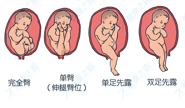 犹如盘膝而坐; 不完全臀为单足或双足先露