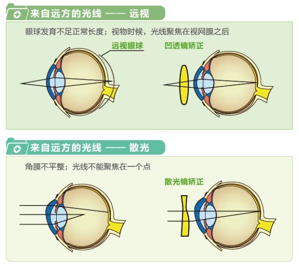 【爱尔课堂】儿童视力检查存在"远视"正常吗?