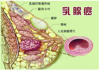 多发性乳腺囊肿钟爱三类女性 说不定就有你!