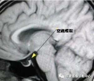 【影像交流】空泡蝶鞍原来有这么多病因