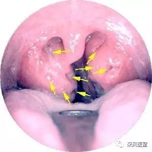 3. 腺样体和扁桃体,一定要同时都切除吗?只切其中之一可以么?