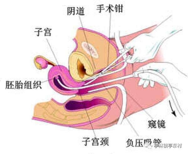 人流并发症