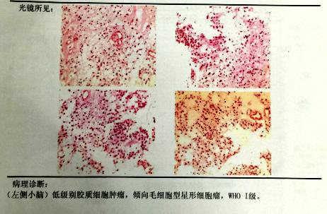 病例手术治愈小脑毛细胞星形细胞瘤一例