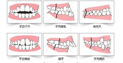 "羊城爱牙工程"口腔知识普及,牙不齐种类有哪些