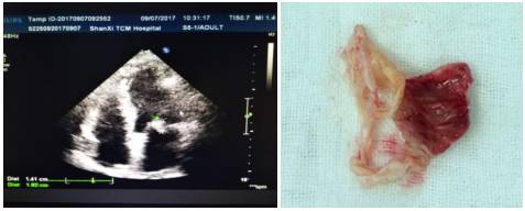 5c㎡赘生物,随心脏瓣膜的活动,在心脏内来回摆动,随时都有脱落