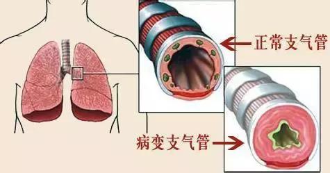 咳!咳!咳嗽总好不了,是慢性支气管炎吗?