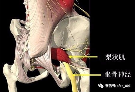 干货|如何应对梨状肌综合症?