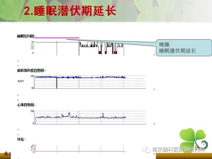 多导睡眠监测在神经科疾病中的临床应用