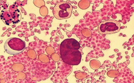 再生障碍性贫血疾病的病理特征