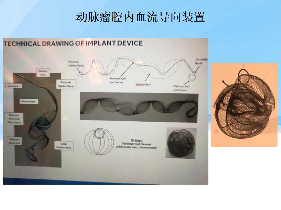 不同类型颅内支架在脑动脉瘤治疗中的应用