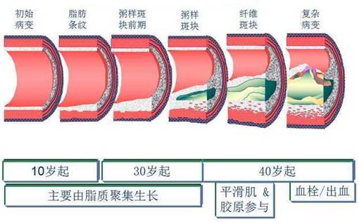 动脉粥样硬化是导致心血管疾病的主要原因,内皮细胞损害是动脉粥样