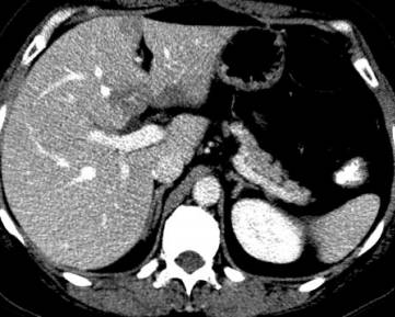 ct   肝脏局部脂肪沉积 轴位可见门脉期镰状韧带旁,肝门旁低密度区