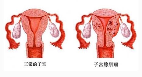 如何及早发现子宫肌瘤症状