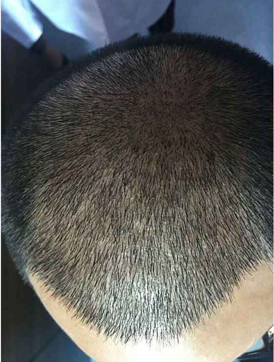确保术后头发生长自然,不杂乱,头发生长密度接近原有头发的生长密度