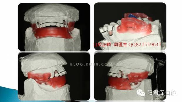 twinblock矫治器