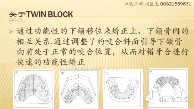 twin-block矫治器