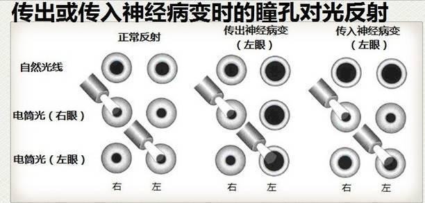 神经病变时瞳孔对光的反射