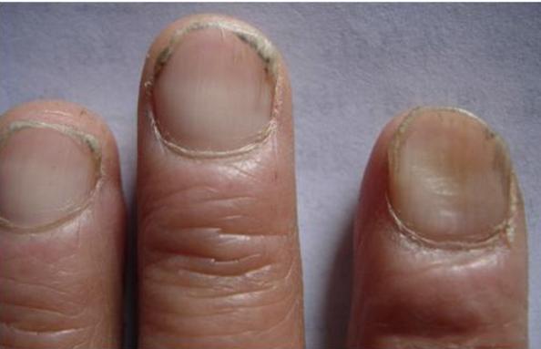 为什么医生看贫血要看指甲,贫血的指甲会有哪些反应?