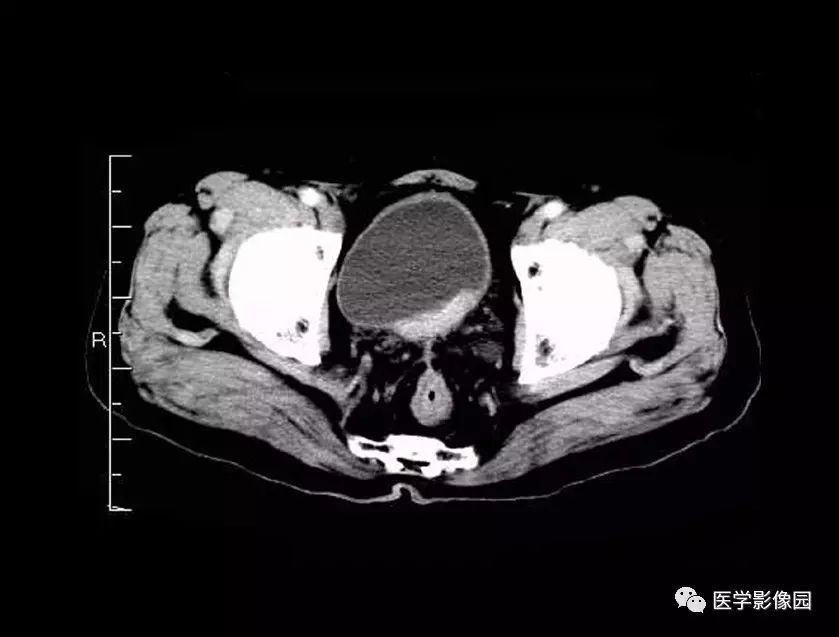 增强扫描肿瘤呈均匀性明显强化 图7-2-32 膀胱癌 ct平扫见膀胱被不