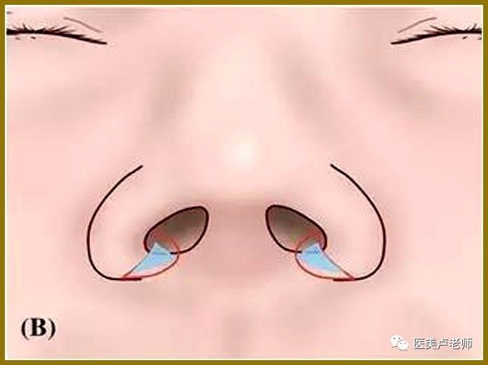 鼻基底缩窄避免鼻槛切迹的方法