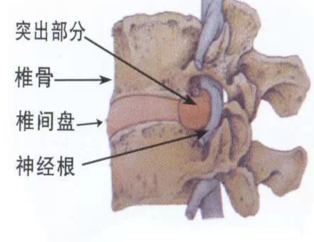 腰椎间盘突出的根不在于骨头而在于筋千万别给医生切啦