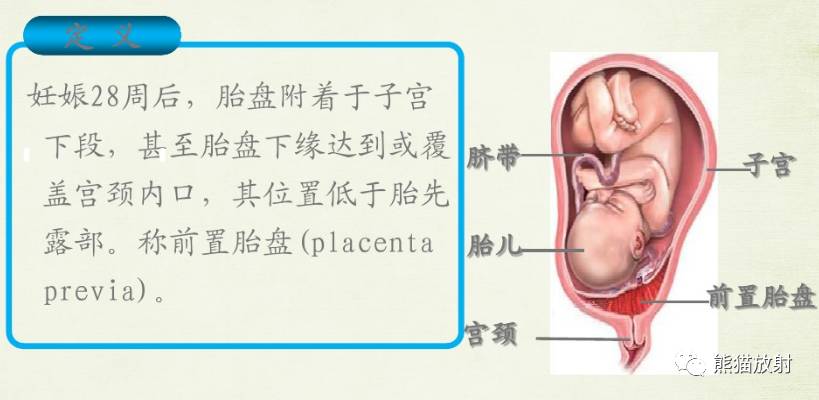 专题前置胎盘与胎盘植入