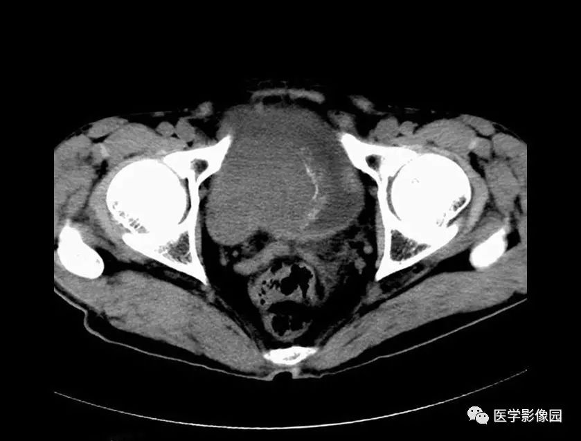 ct平扫见一突向膀胱腔内的结节状肿块(↑), 基底附着于膀胱前壁