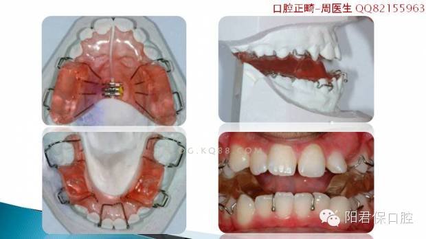 twinblock矫治器