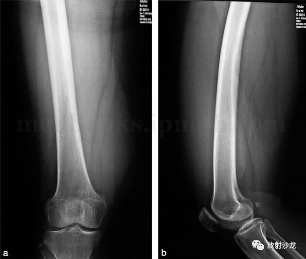 图49‐2 x 线示右大腿远端软组织内梭形肿物,右股骨骨皮质完整,未见