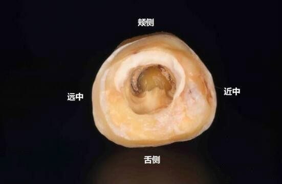 图解| c形根管形态,分类及治疗!